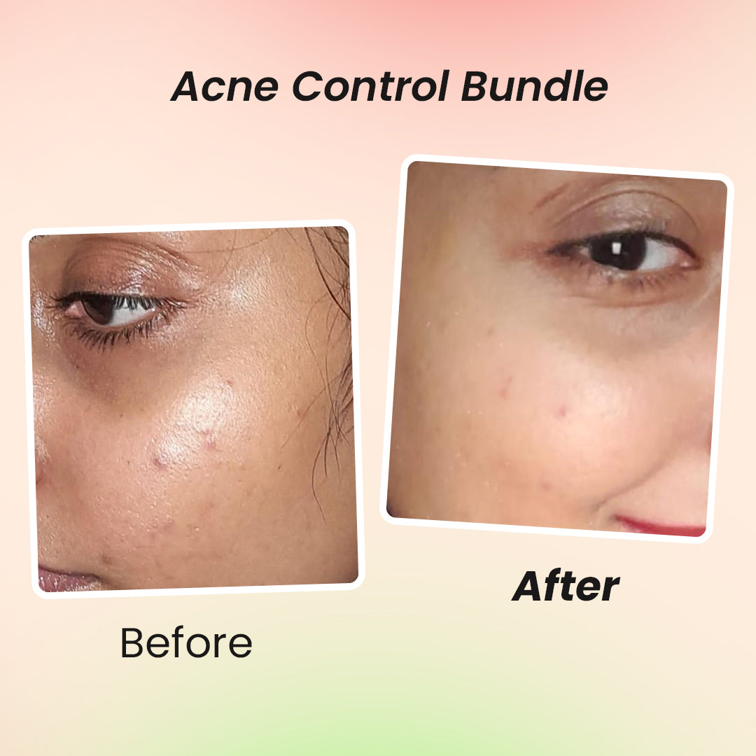 Acne Control Bundle